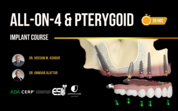 ALL-ON-4 and Pterygoid Implant